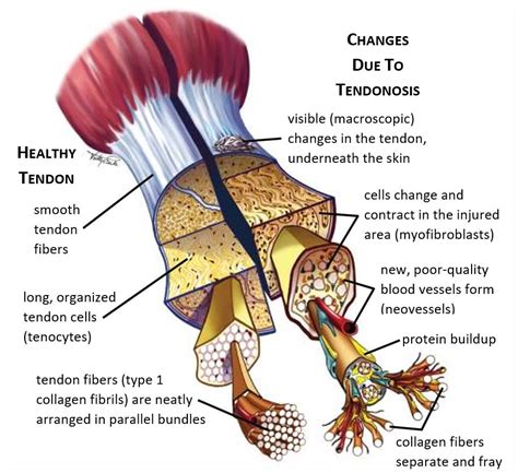 MCGrawHill Healthy Tendon v Tendinosis Labeled | UNC Orthopaedics