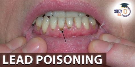 Lead Poisoning