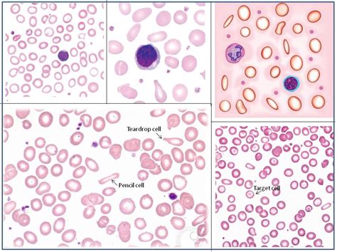 Iron-deficiency-anemia