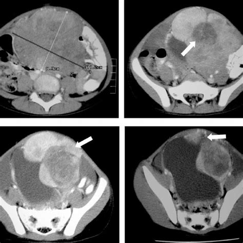 Abdominopelvic CT scan revealed a multilobed heterogeneous mass with... | Download Scientific ...