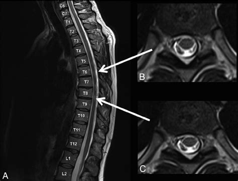 Examples of spinal cord lesions detected only on sagittal scans ( A )... | Download Scientific ...