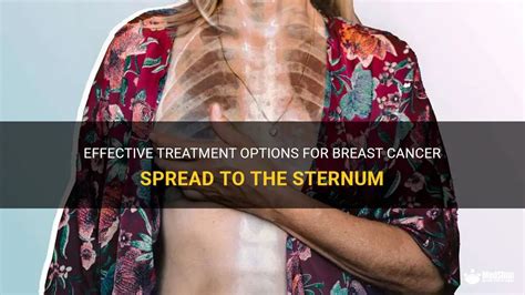 Effective Treatment Options For Breast Cancer Spread To The Sternum | MedShun