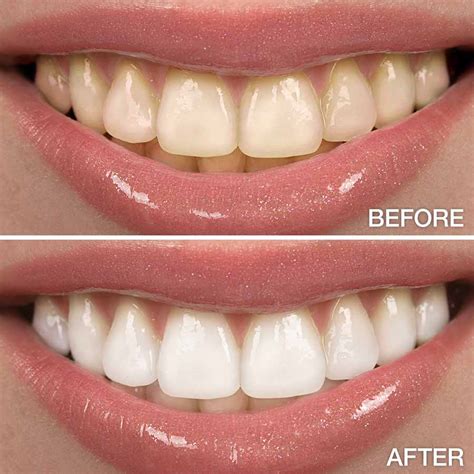 Professional Teeth Whitening in Seattle