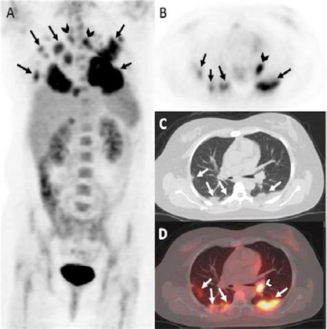 Pet Scan Images Lung Cancer