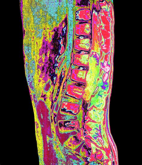 Spinal Cord Cancer Mri Photograph by Mehau Kulyk - Pixels