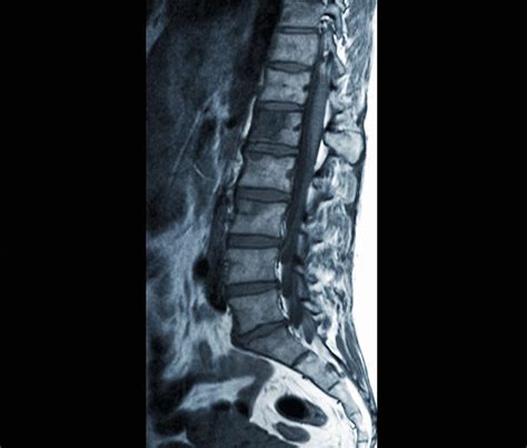 Secondary Spinal Cancer, Mri Scan Photograph by Science Photo Library