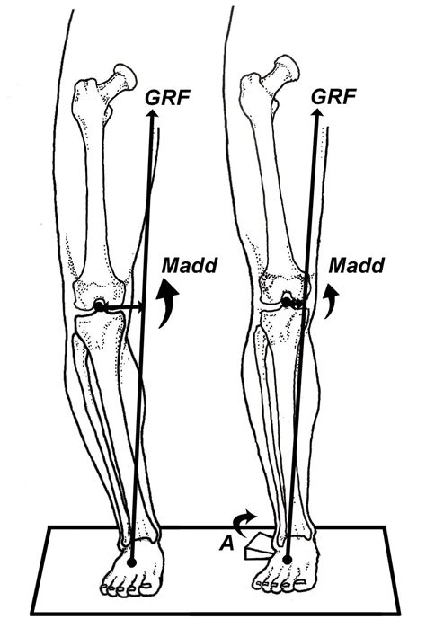 Valgus Vs Varus Of Ankle