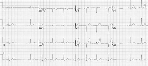 Sinoatrial Exit Block • LITFL • ECG Library Diagnosis