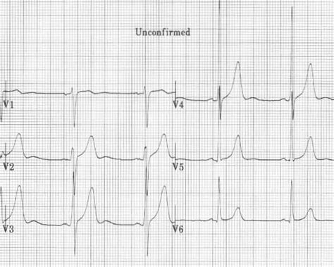 U Wave • LITFL Medical Blog • ECG Library Basics