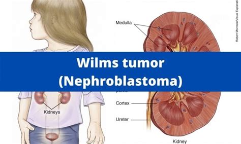 Wilms tumor (Nephroblastoma) | Medical Junction