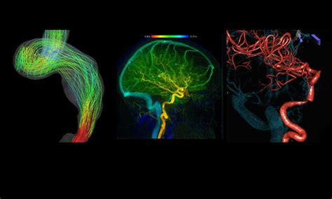 Pulsatile Tinnitus Causes and Treatments | UCSF Radiology