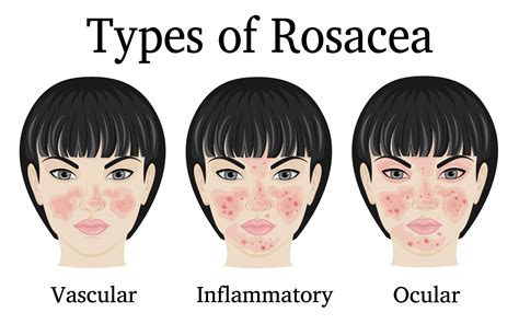 Rosacea and Ocular Rosacea Treatment | Ophthalmologist | Eye Health ...