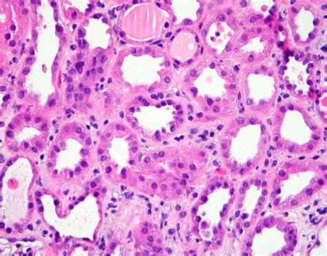 Pathology Outlines - Acute tubular necrosis