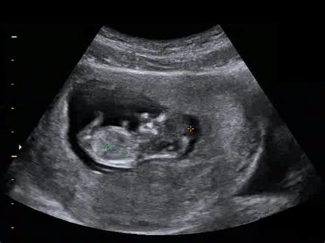 Gender Ultrasound: Detect Baby Gender Ultrasound