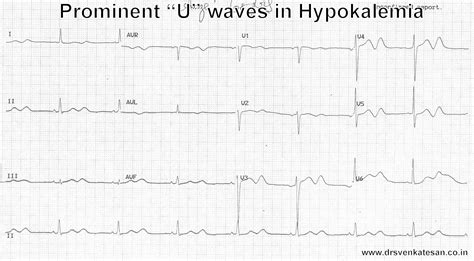 hypokalemia in ecg | Dr.S.Venkatesan MD