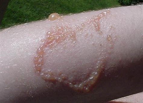 Three Myths (and Facts) About Poison Ivy Rash | Appalachian Mountain Club (AMC)