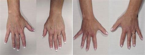 Before & After Hand Lift Surgery | Plastic surgery, Fat transfer, Rejuvenation