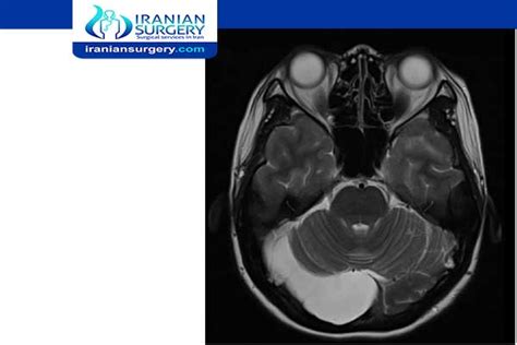 Arachnoid cyst treatment without surgery | Iranian Surgery