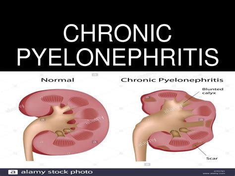 Pyelonephritis, ACUTE PYELONEPHRITIS, CHRONIC PYELONEPHRITIS,