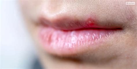 How To Get Rid Of A Pimple On Lip: Treatments Guide - WomenMagazine