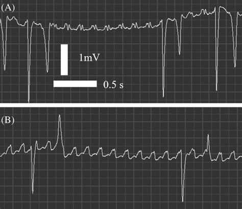 Base‐apex electrocardiogram (ECG) at rest before the procedure, with ...