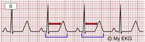 Hypocalcemia Ecg Changes