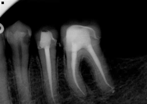 Root Canal Pain is a Sign You Need to See a Dentist ASAP