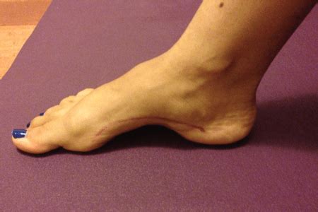 High Arches & Outwardly Pointed Feet - A Deep Dive Guide : AdvancedPosture