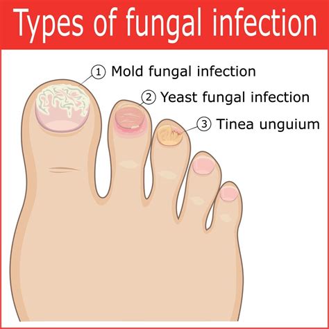 7 TOENAIL FUNGUS PREVENTION YOU MUST KNOW