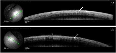 Edema space detected between the layers of the sclera (white arrows) in... | Download Scientific ...