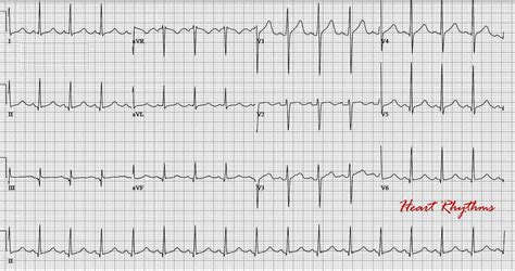 ECG Rhythms: Prolonged QTc due to hypocalcemia