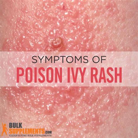 Poison Ivy Rash: Stages, Causes, Symptoms & Treatment