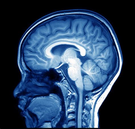 magnetic resonance image (MRI) of the brain - ODC