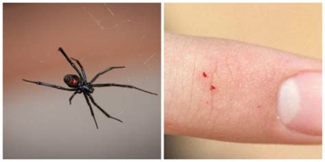 What To Do After A Black Widow Bite - How to Remove a Tick Head Stuck in Your Skin - Mom Goes ...