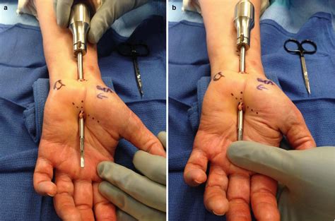 Endoscopic Carpal Tunnel Release | Plastic Surgery Key