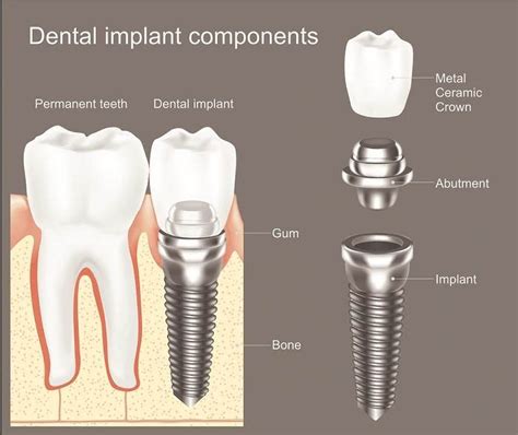 Types Of Dental Implants