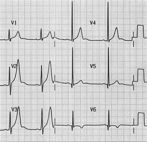 U Wave • LITFL Medical Blog • ECG Library Basics