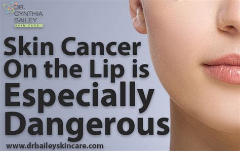 Skin cancer on the lip can be avoided with these dermatologist's tips!