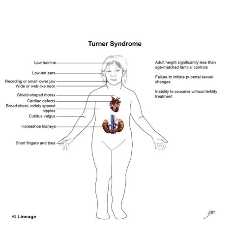 Turner Syndrome - USMLE Strike