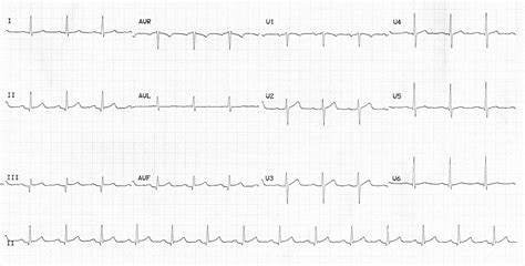 Anterior Myocardial Infarction Litfl Ecg Library 27840 | Hot Sex Picture