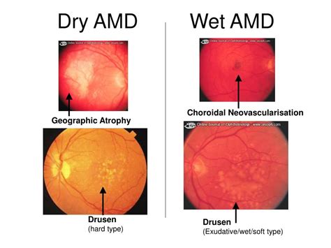 Wet Amd Symptoms