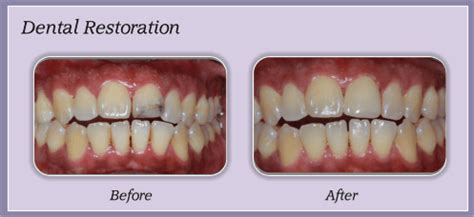 restoration-before-after | Family Care Dental Group