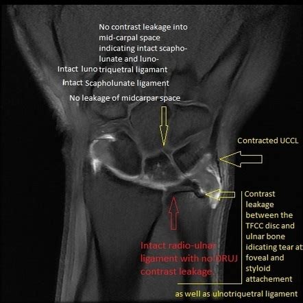 Ulnar Collateral Ligament Wrist Mri