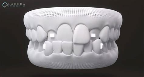 What Are Invisalign Attachments and When Are They Needed?