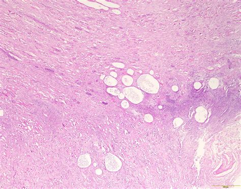 Chronic Pyelonephritis Histology