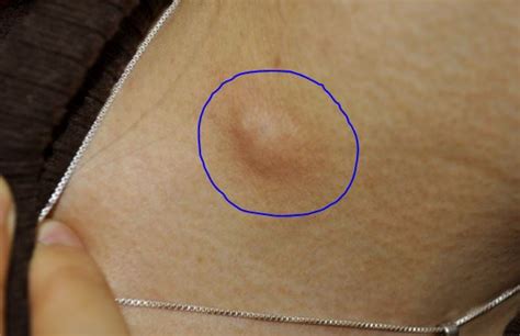 Cysts On Armpit | www.pixshark.com - Images Galleries With A Bite!