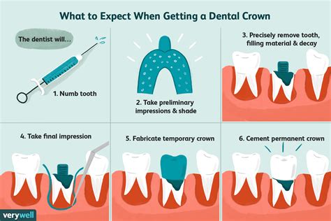 Dental Crown Replacement Procedure