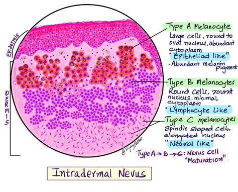 Intradermal Nevus - Pathology Made Simple