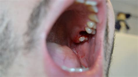 What Does Dry Socket Look Like After Wisdom Tooth Extraction