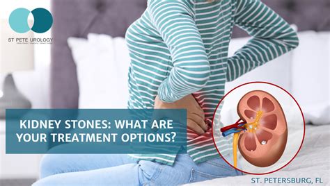 Kidney stones: What are your treatment options? | St Pete Urology